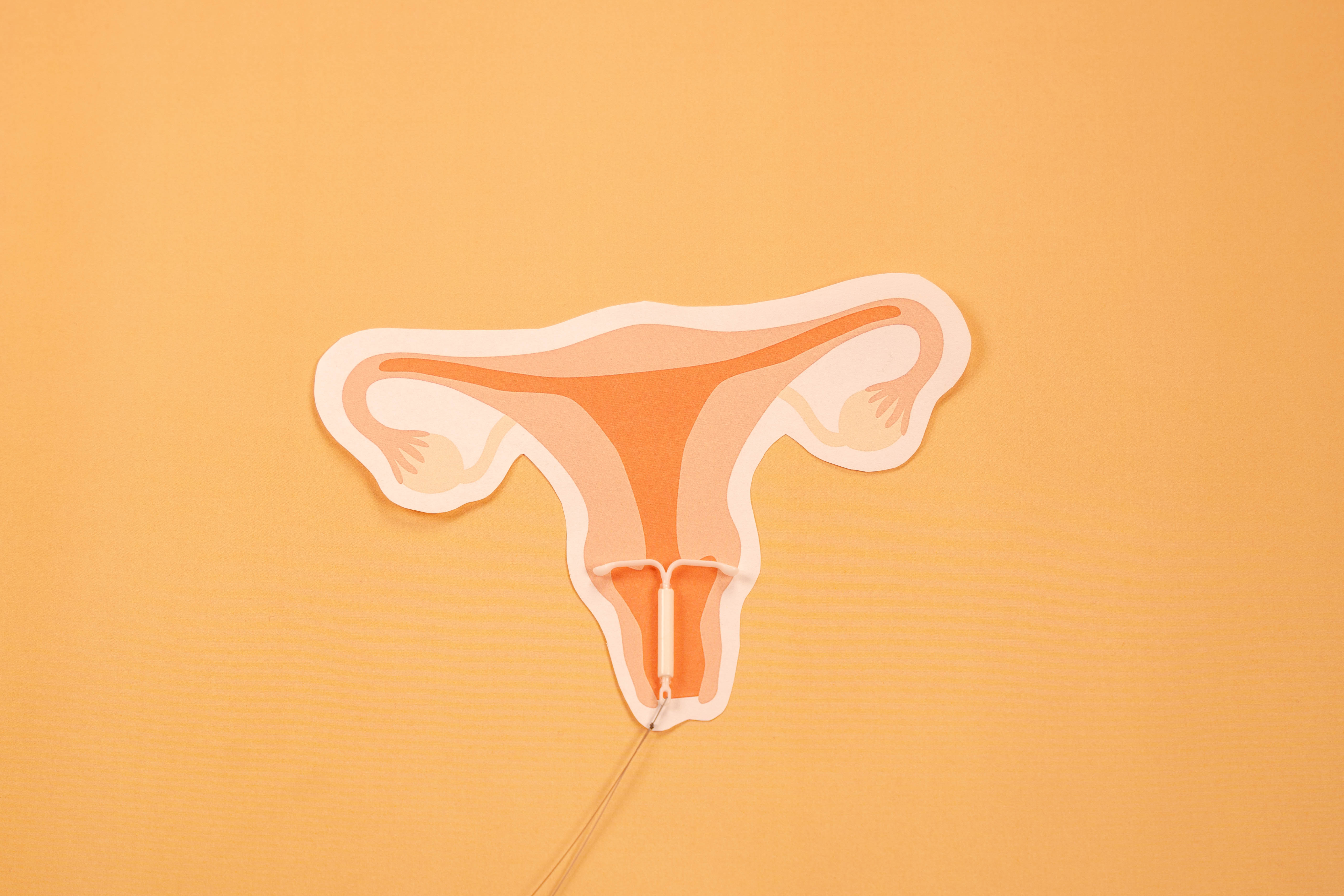 Tegning av kvinnelige reproduksjonsorganer med en innsatt spiral. 