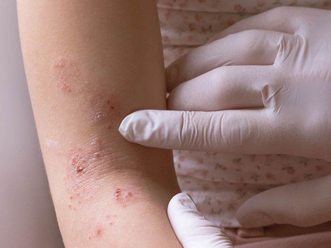 lege med hansker undersøker eksem på arm.