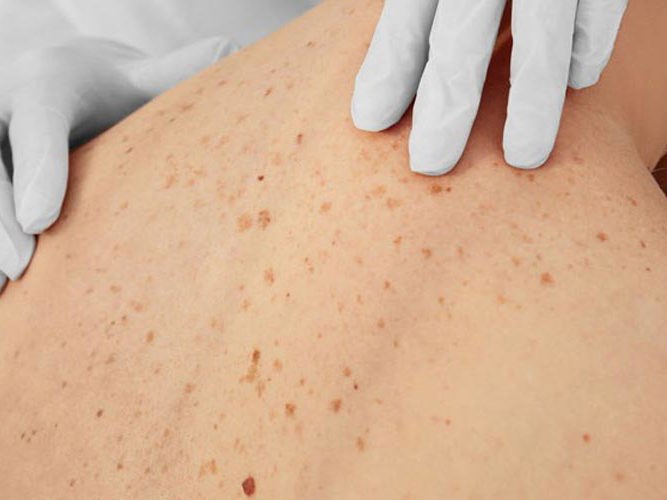 hudlege undersøker rygg for føflekker.