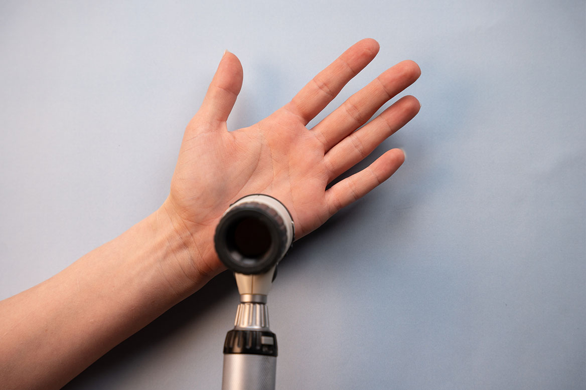 En hånd som blir undersøkt med et dermatoskop.