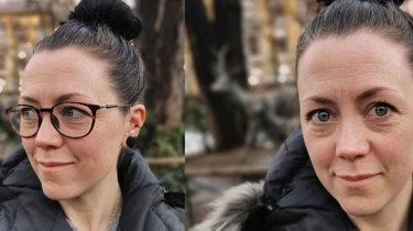 Pasient Hannah med og uten briller, før og etter laseroperasjon på Aleris.