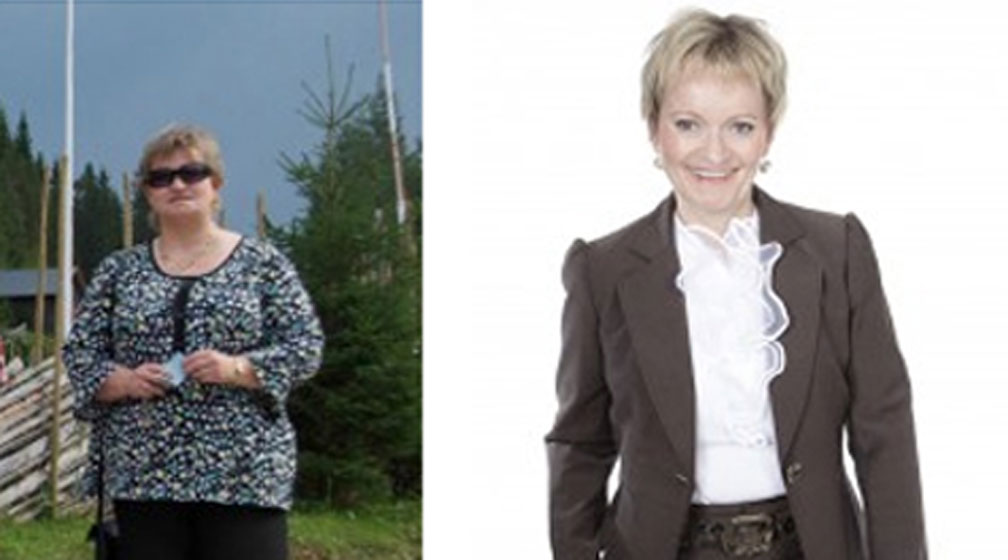 Mona før og etter slankeoperasjon. 