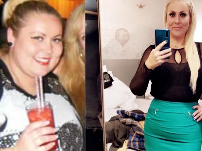 Anita før og etter SASI-operasjon.